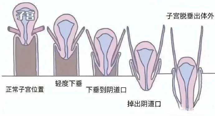 子宫脱垂。,代孕公司哪里靠谱